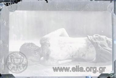 Mutilated man, victim of the Turks