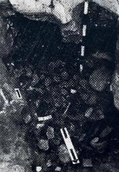 ΝΝΑ κοιλότης 1.